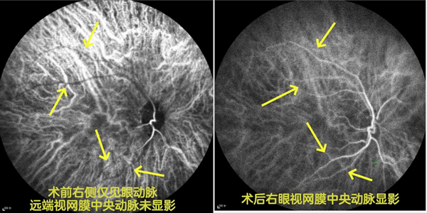 八旬老伯轻信短视频停服降压降糖药 突发“眼中风”致右眼失明